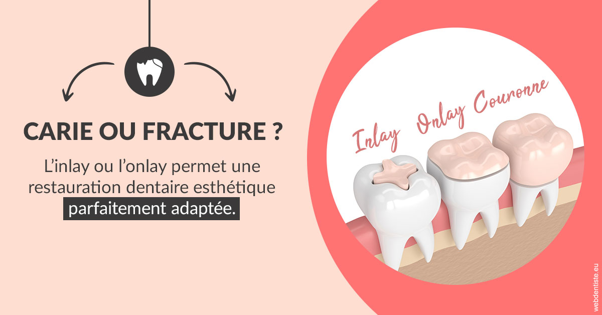 https://dr-chapon-frederic.chirurgiens-dentistes.fr/T2 2023 - Carie ou fracture 2
