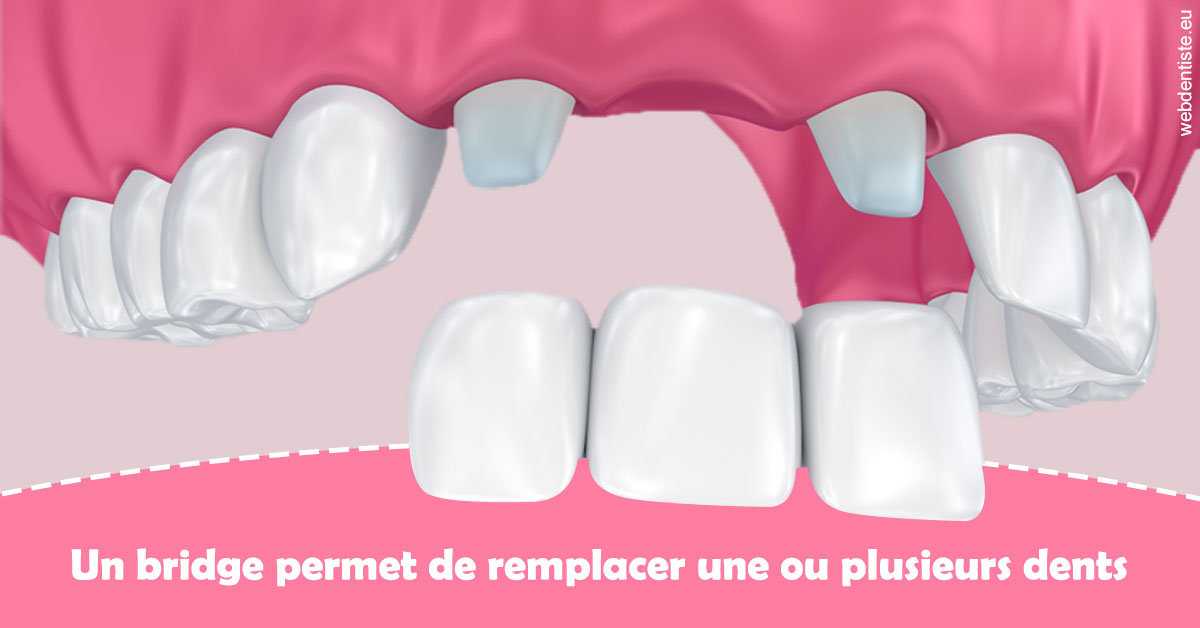 https://dr-chapon-frederic.chirurgiens-dentistes.fr/Bridge remplacer dents 2