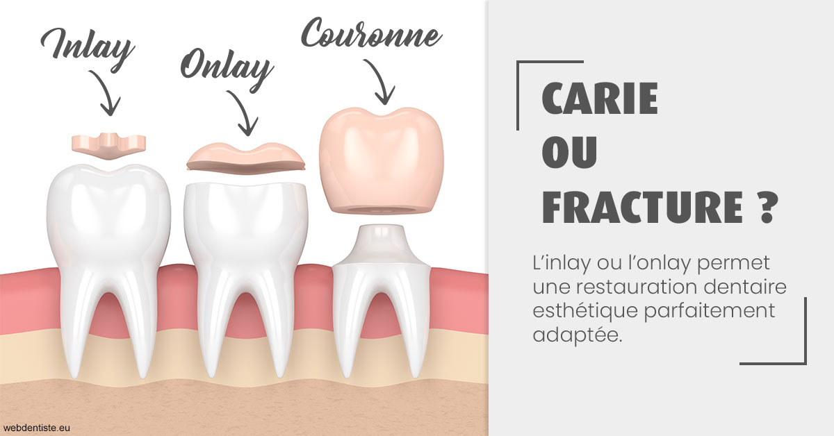 https://dr-chapon-frederic.chirurgiens-dentistes.fr/T2 2023 - Carie ou fracture 1