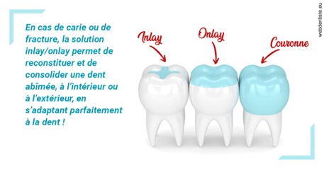 https://dr-chapon-frederic.chirurgiens-dentistes.fr/L'INLAY ou l'ONLAY