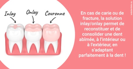 https://dr-chapon-frederic.chirurgiens-dentistes.fr/L'INLAY ou l'ONLAY 2