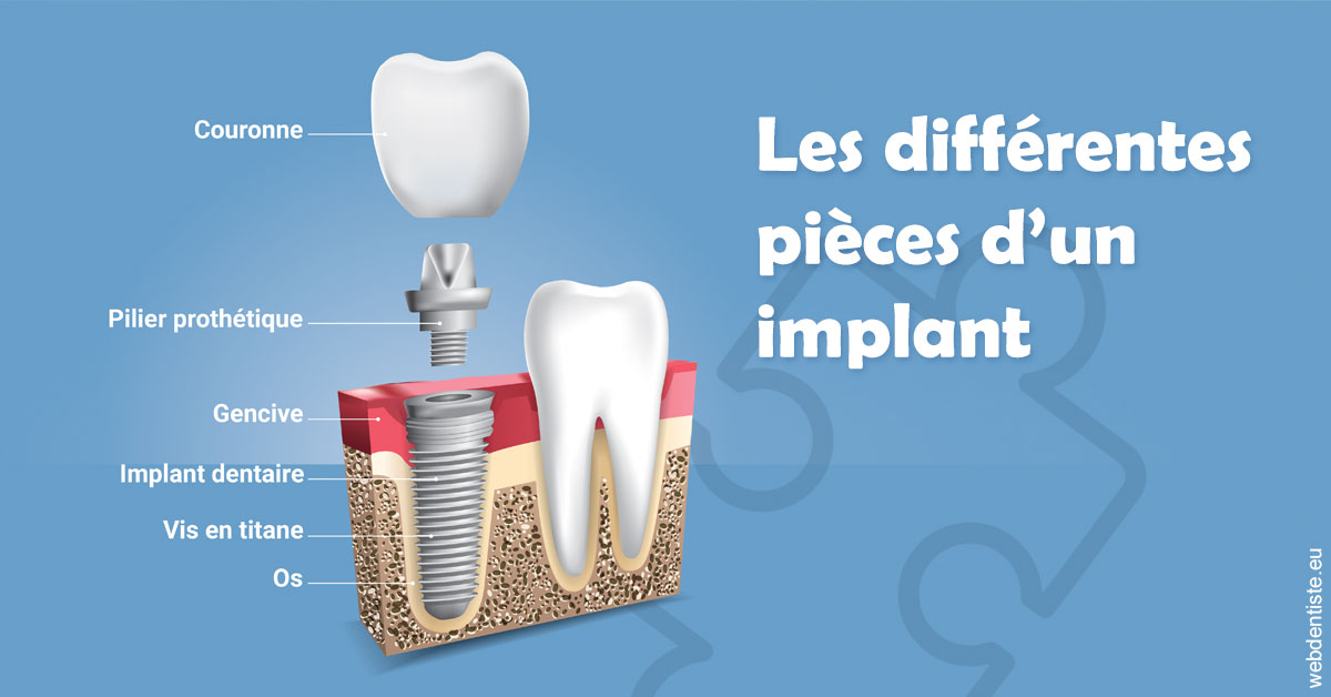 https://dr-chapon-frederic.chirurgiens-dentistes.fr/Les différentes pièces d’un implant 1