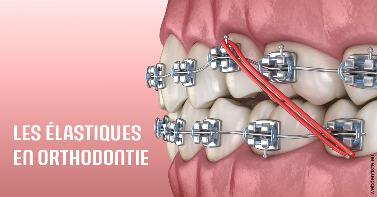 https://dr-chapon-frederic.chirurgiens-dentistes.fr/Elastiques orthodontie 2